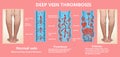 Thrombosis. From Normal blood flow to Blood clot formation