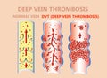 Thrombosis. From Normal blood flow to Blood clot formation