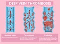 Thrombosis. From Normal blood flow to Blood clot formation