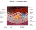 Thrombus, blood clot, unstable plaque Royalty Free Stock Photo