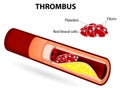 Thrombus