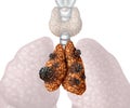 Thymus Cancer