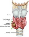 Thyroid cancer 3d medical illustration with nymph nodes on white backround