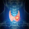 Thyroid cancer Royalty Free Stock Photo