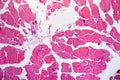 Thyroid cancer, light micrograph