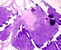 Thyroid cancer: Metastatic papillary carcinoma of thyroid. Reactive change. Lymph node carcinoma. Royalty Free Stock Photo