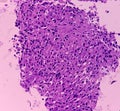 Thyroid cancer: Microscopic image of Follicular neoplasm. Malignant neoplasm of atypical thyroid follicular epithelial cells.