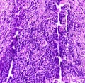Thyroid cancer: Microscopic image of Follicular neoplasm. Malignant neoplasm of atypical thyroid follicular epithelial cells.