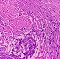 Thyroid cancer: Malignant neoplasm of atypical thyroid follicular epithelial cells.