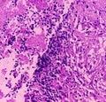 Thyroid cancer: Microscopic image of Follicular neoplasm. Malignant neoplasm of atypical thyroid follicular epithelial cells.