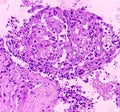 Thyroid cancer: Microscopic image of Follicular neoplasm. Malignant neoplasm of atypical thyroid follicular epithelial cells.