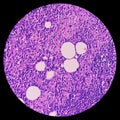 Thyroid cancer: Microscopic image of Metastatic papillary carcinoma of thyroid. Reactive change. Lymph node carcinoma Royalty Free Stock Photo