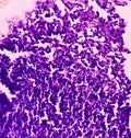 Thyroid cancer: Microscopic image of Metastatic papillary carcinoma of thyroid. Reactive change. Lymph node carcinoma Royalty Free Stock Photo