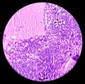 Thyroid cancer: Microscopic image of Metastatic papillary carcinoma of thyroid. Reactive change. Lymph node carcinoma Royalty Free Stock Photo