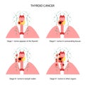 Thyroid cancer stages