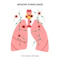 Thyroid cancer stages