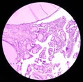 Thyroid cancer. Tracheal gland involved by tumor. Microscopic image of Metastatic papillary carcinoma of thyroid. Royalty Free Stock Photo