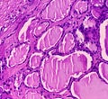 Thyroid cancer. Tracheal gland involved by tumor. Microscopic image of Metastatic papillary carcinoma of thyroid. Royalty Free Stock Photo