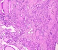 Thyroid cancer. Tracheal gland involved by tumor. Microscopic image of Metastatic papillary carcinoma of thyroid Royalty Free Stock Photo