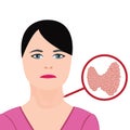 Thyroid disease. Endocrine disfunction vector illustration Royalty Free Stock Photo