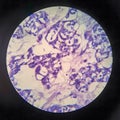 Thyroid follicular carcinoma, light micrograph