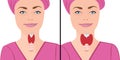 Thyroid healthy and enlarged thyroid. hypothyroid vector illustration Royalty Free Stock Photo