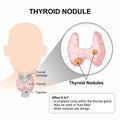 Thyroid Nodule, ENT Medical Flashcard Royalty Free Stock Photo