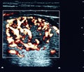 Thyroid nodule ultrasound Royalty Free Stock Photo
