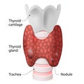 Thyroid Nodules Royalty Free Stock Photo