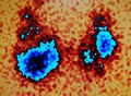 Thyroid pathology,nuclear medicine