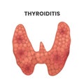 Thyroiditis illustration. vector illustration of the inflamed thyroid gland