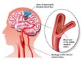 TIA (transient ischemic attack)