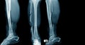 Tibia fracture Royalty Free Stock Photo