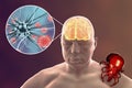 Tick-borne encephalitis concept