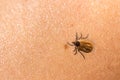 Tick filled with blood crawling on human body skin