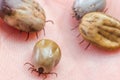 Tick filled with blood sitting on human skin