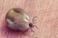 Tick filled with blood sitting on human skin