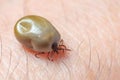 Tick filled with blood sitting on human skin