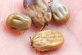 Tick filled with blood sitting on human skin