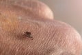 tick on human skin bites and carries disease Royalty Free Stock Photo