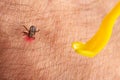 tick on human skin. Tweezers for extracting ticks Royalty Free Stock Photo