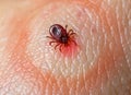 tick on skin with erythema migrans - lyme disease symptoms