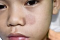 Tinea faciei or Fungal Infection on face of Asian two years old child Royalty Free Stock Photo