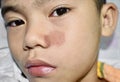 Tinea faciei or Fungal Infection on face of Asian two years old child