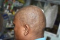 Tinea infection at scalp. It is a fungal infection that causes scaly and itching