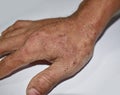 Tinea manus or Fungal Infection on hand of Southeast Asian, Burmese adult man.
