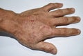 Tinea manus or Fungal Infection on hand of Southeast Asian, Burmese adult man.