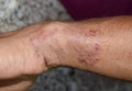 Tinea manus or Fungal Infection on wrist of Southeast Asian, Burmese adult man.