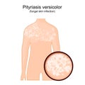 Tinea versicolor. Human body with symptoms of pityriasis versicolor