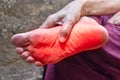 Tingling and burning sensation in foot of Asian man. Foot pain. Sensory neuropathy problems. Foot nerves problems. Plantar